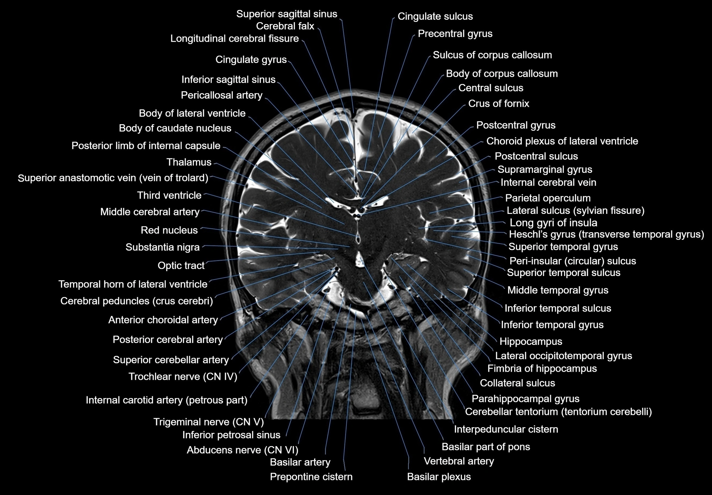 MRI Brain coronal cross sectional labelled anatomy 3T image  -img-00001-00040.webp